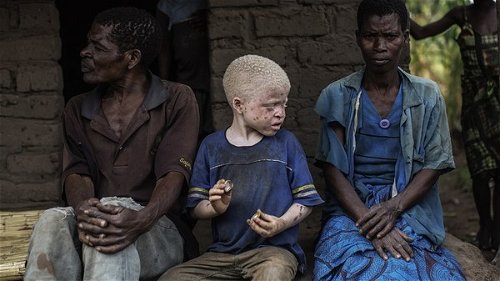 Malawi: steeds meer mensen met albinisme vermoord voor toverdrankjes