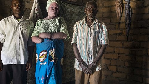 Malawi: nieuwe golf van aanvallen op mensen met albinisme